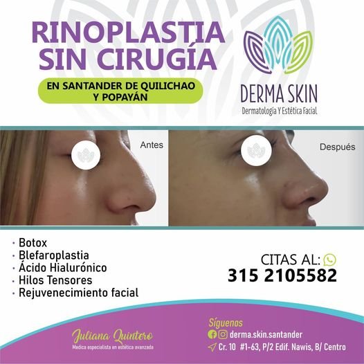 Rinoplastia sin cirugía en Santander de Quilichao